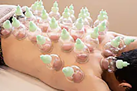 バンキー療法（吸玉）